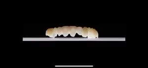 eldyplus_ästhetik_schiene_splint_dental_veneer_provisorium_dental_fräszentrum_digitale_zahntechnik